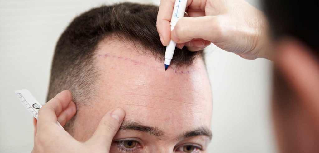 Opening Canals in Hair Transplant Procedure