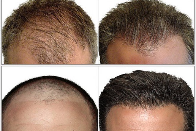 The 5 Critical Points in a Successful Hair Transplant | MyHairTR