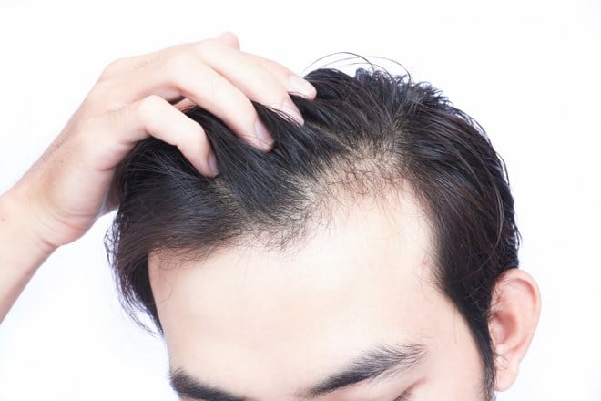 Hair Transplant Pros and Cons