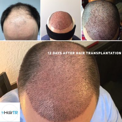 Before After hair transplant
