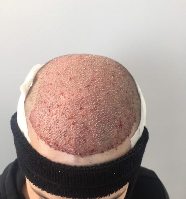 After hair transplant operation Myhairtr