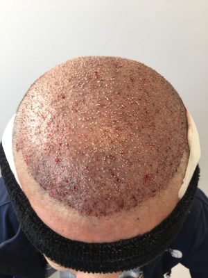 After hair transplant operation